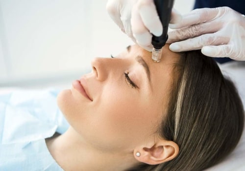 Microneedling After Fitness Center: A Perfect Combo For Healthy, Radiant Skin